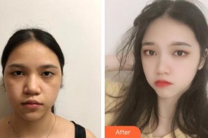 秦皇島紀輝整形美容醫(yī)院王雯整形價格表附去痘印痘坑案例展示