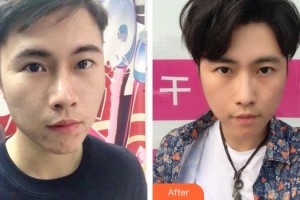 秦皇島紀輝整形美容醫(yī)院湯旭整形價格表附清潔祛痘案例展示