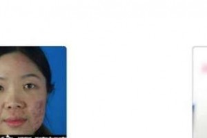 秦皇島紀輝整形美容醫(yī)院金翰相整形價格表附清潔祛痘案例展示