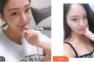 秦皇島巧致美容醫(yī)院王立英整形價格表附光子嫩膚案例展示