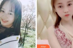 秦皇島巧致美容醫(yī)院任加偉整形價格表附埋線提升案例展示