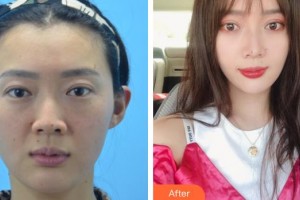 秦皇島紀輝整形美容醫(yī)院江川整形價格表附埋線提升案例展示