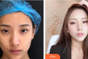 秦皇島紀輝整形美容醫(yī)院鄭杰整形價格表附埋線提升案例展示