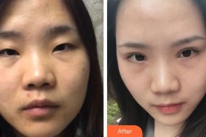 秦皇島巧致美容醫(yī)院于民整形價(jià)格表附切開(kāi)雙眼皮案例展示