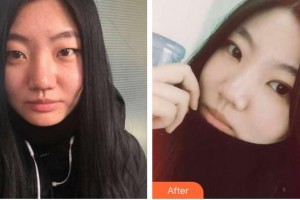 秦皇島紀輝整形美容醫(yī)院崔炳龍教授整形價格表附埋線雙眼皮案例展示