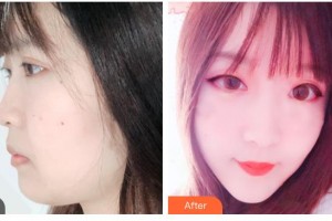 秦皇島友誼醫(yī)院整形美容外科王國(guó)光整形價(jià)格表附埋線提升案例展示