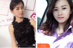 秦皇島巧致美容醫(yī)院高華整形價(jià)格表附切開(kāi)雙眼皮案例展示