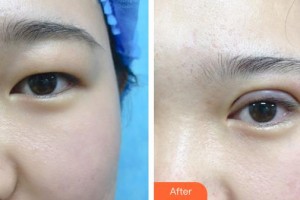 秦皇島念奴嬌醫(yī)療美容門(mén)診部王權(quán)整形價(jià)格表附眼部綜合案例展示