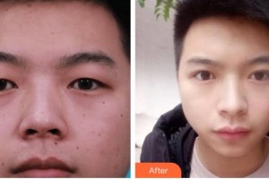 秦皇島念奴嬌醫(yī)療美容門(mén)診部馬艷艷整形價(jià)格表附切開(kāi)雙眼皮案例展示