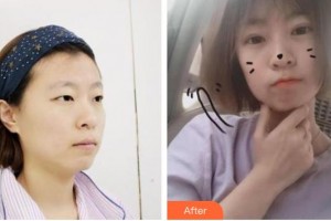 秦皇島念奴嬌醫(yī)療美容門(mén)診部康凱整形價(jià)格表附切開(kāi)雙眼皮案例展示