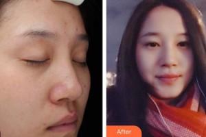 秦皇島巧致美容醫(yī)院咸福實整形價格表附祛斑祛痣案例展示