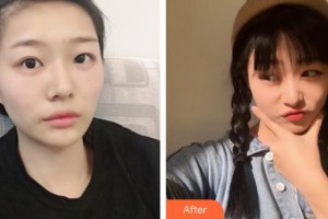 秦皇島慈善醫(yī)院整形美容科謝冰整形價(jià)格表附激光點(diǎn)痣案例展示