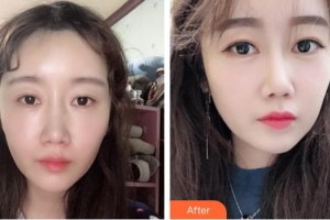 秦皇島東方皮膚醫(yī)學(xué)門(mén)診部王彩霞整形價(jià)格表附去痘印痘坑案例展示