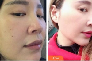 秦皇島愛(ài)爾眼科醫(yī)院王東英整形價(jià)格表附鼻部綜合案例展示