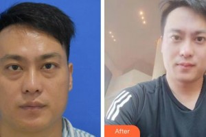 秦皇島愛(ài)爾眼科醫(yī)院張海東整形價(jià)格表附激光去眼袋案例展示