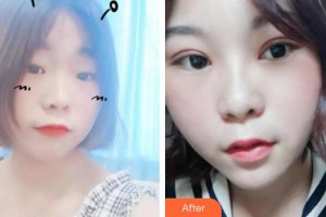 秦皇島美姿嬌醫(yī)療美容診所李金海整形價(jià)格表附眼部綜合案例展示