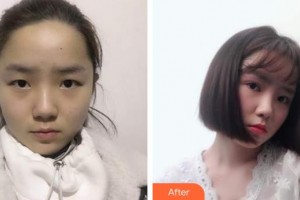 秦皇島和生醫(yī)療美容門(mén)診部劉雷整形價(jià)格表附眼部綜合案例展示