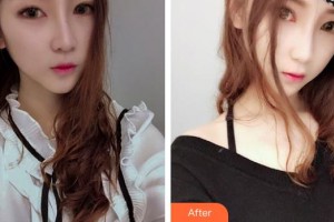 秦皇島愛(ài)爾眼科醫(yī)院張一凡整形價(jià)格表附埋線雙眼皮案例展示