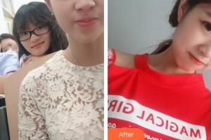 秦皇島愛(ài)爾眼科醫(yī)院張巖整形價(jià)格表附切開(kāi)雙眼皮案例展示