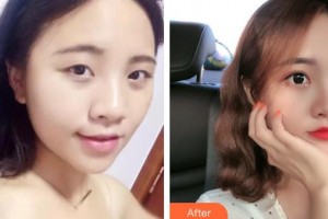 秦皇島愛(ài)爾眼科醫(yī)院薛巖整形價(jià)格表附眼部綜合案例展示