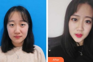 秦皇島巧致整形醫(yī)院楊哲整形價(jià)格表附切開(kāi)雙眼皮例展示