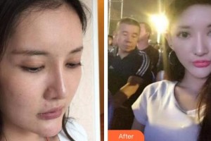 秦皇島巧致美容醫(yī)院田肖南整形價(jià)格表附埋線提升案例展示