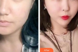 秦皇島東方皮膚醫(yī)學門診部馬嚴整形價格表附埋線提升案例展示