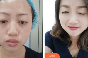 唐山光明醫(yī)院馬允錦整形價格表附祛斑祛痣案例展示