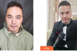 唐山冀東眼科醫(yī)院劉淑偉整形價格表附內切祛眼袋案例展示