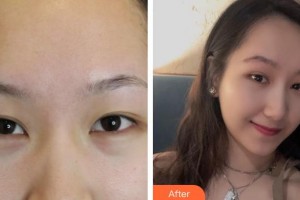 唐山冀東眼科醫(yī)院于秋菊整形價格表附切眉術案例展示