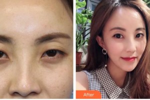 唐山冀東眼科醫(yī)院李春江整形價格表附眼部綜合案例展示