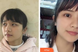 唐山冀東眼科醫(yī)院周存江整形價格表附切開雙眼皮案例展示