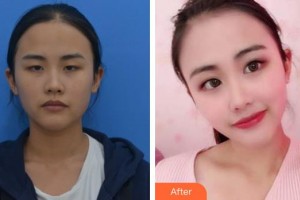 唐山光明醫(yī)院高斌儒整形價格表附定點雙眼皮案例展示