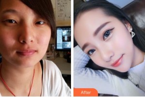 唐山冀東眼科醫(yī)院陳惠茹整形價格表附定點雙眼皮案例展示