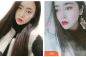 唐山牙博士口腔醫(yī)院張靜整形價格表附金屬托槽矯正案例展示