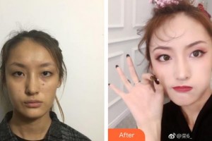 唐山星光醫(yī)療美容門診部白玲整形價格表附去痘印痘坑案例展示