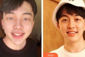 唐山牙博士口腔醫(yī)院張賀萍整形價格表附美白貼片案例展示