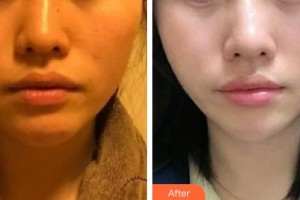 邯鄲都市整形美容醫(yī)院李正曄整形價格表附埋線提升案例展示