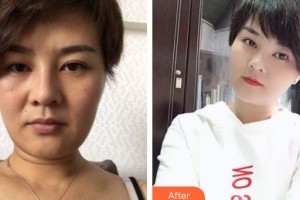 邯鄲曲勝星范醫(yī)療美容門診部曲秀麗醫(yī)師整形價格表附埋線提升案例展示