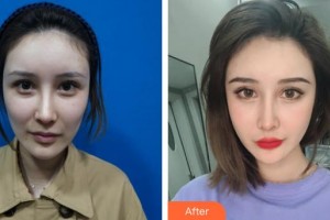 邯鄲都市整形美容醫(yī)院朱洪濤整形價格表附埋線提升案例展示