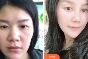 邯鄲京美整形醫(yī)院陳阿喜整形價格表附鼻骨矯正案例展示