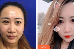 邯鄲京美整形醫(yī)院安在勛整形價格表附埋線提升案例展示