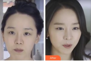 邯鄲都市整形美容醫(yī)院吉志俊整形價格表附埋線提升案例展示