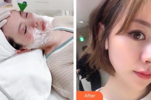 邢臺手外科醫(yī)院整形美容科高健整形價格表附埋線提升案例展示