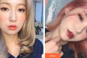 邢臺(tái)人民醫(yī)院醫(yī)學(xué)美容科張玉整形價(jià)格表附埋線提升案例展示