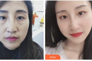 邢臺(tái)美加美醫(yī)療美容診所韓美整形價(jià)格表附定點(diǎn)雙眼皮案例展示