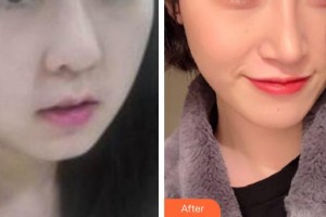 保定藍(lán)山醫(yī)療美容醫(yī)院王儉整形價(jià)格表附埋線提升案例展示