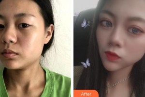 保定寶特醫(yī)療美容診所梁騫整形價(jià)格表附埋線提升案例展示