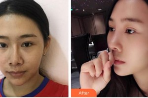 保定市第五醫(yī)院美容整形科楊瑞萍整形價(jià)格表附埋線提升案例展示