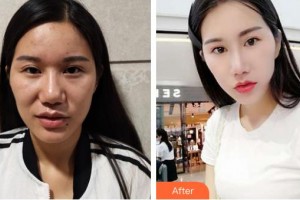 保定市第五醫(yī)院美容整形科單敬依整形價(jià)格表附鼻部綜合案例展示